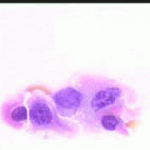 Πολυπυρηνο κύτταρο, αρραιοχρωματικοί ανισομεγέθεις πυρήνες, επίχρισμα του 2003